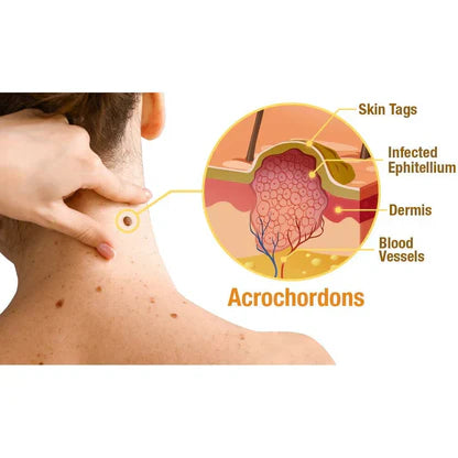 TAGRECEDE-SPRAY TRATAMIENTO DE VERRUGAS Y MANCHAS EN LA PIEL CON VENENO DE ABEJAS